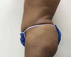 After Tummy Tuck