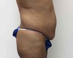 Before Tummy Tuck