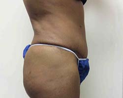 After Tummy Tuck