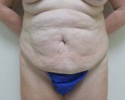 Before Tummy Tuck