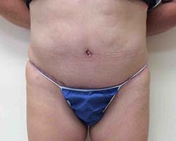 After Tummy Tuck