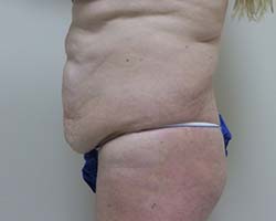 Before Tummy Tuck
