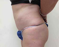 After Tummy Tuck