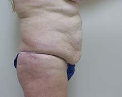 Before Tummy Tuck