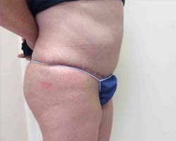 After Tummy Tuck