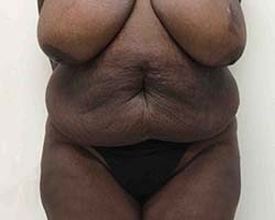Before Tummy Tuck