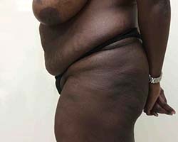Before Tummy Tuck