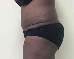 After Tummy Tuck
