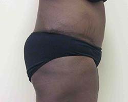 After Tummy Tuck