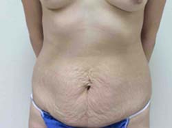 Before Tummy Tuck
