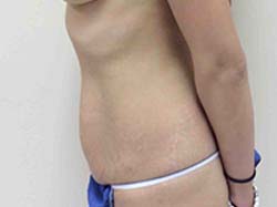 Before Tummy Tuck