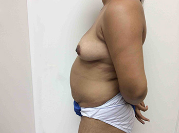 Before Tummy Tuck