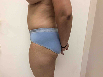 After Tummy Tuck