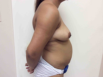 Before Tummy Tuck