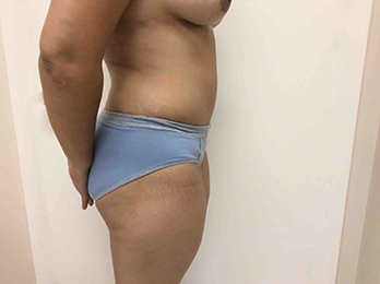 After Tummy Tuck