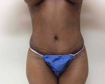 After Tummy Tuck