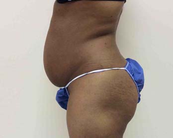 Before Tummy Tuck