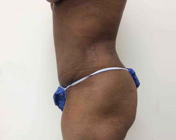 After Tummy Tuck