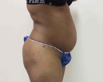 Before Tummy Tuck