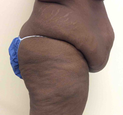 Before Tummy Tuck