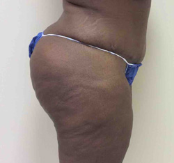 After Tummy Tuck