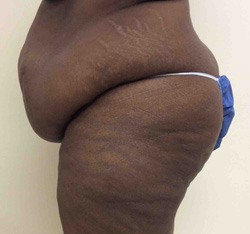Before Tummy Tuck