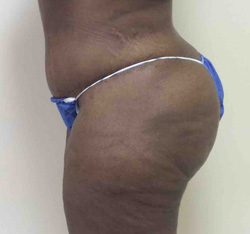 After Tummy Tuck