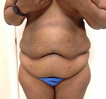 Before Tummy Tuck