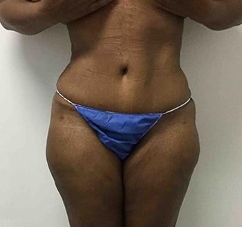 After Tummy Tuck