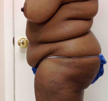 Before Tummy Tuck