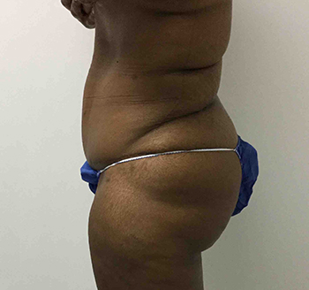 After Tummy Tuck