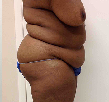 Before Tummy Tuck