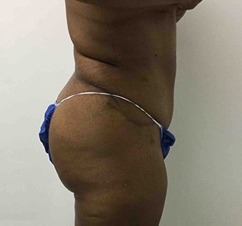 After Tummy Tuck